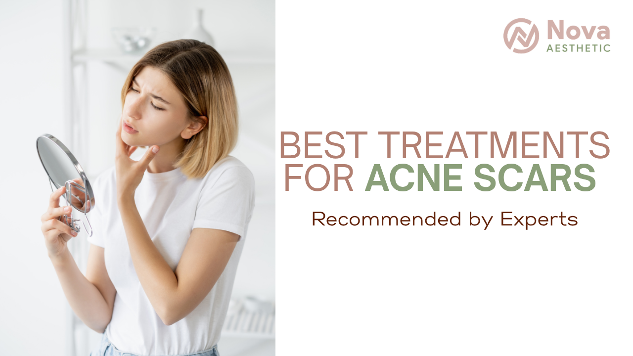 Best Treatments for Acne Scars